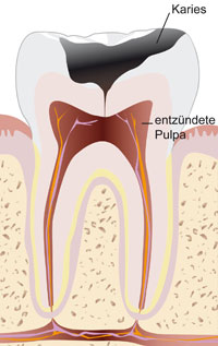 zahnarzt-altenburg-Endodontie